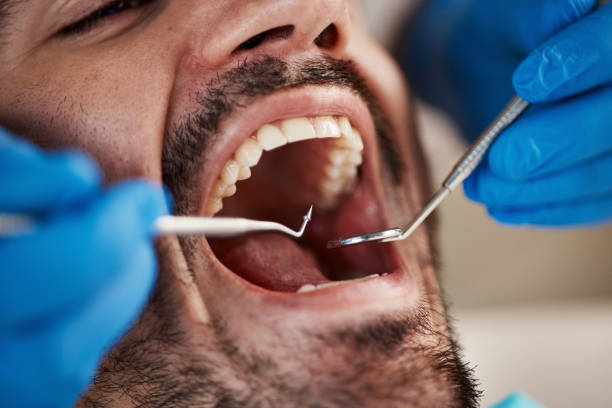Best Emergency Dental Care for Abscessed Tooth in Portola, CA
